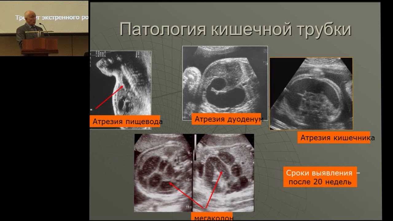 Узи аномалий. УЗИ при патологии беременности. Внутриутробные пороки развития УЗИ. Врожденные пороки развития плода УЗИ. Пороки развития плода на УЗИ.